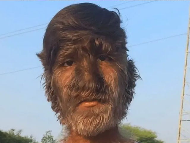 غیر معمولی حالت کے حامل ہندوستانی نوعمر چہرے کے لئے گنیز ریکارڈ طے کرتے ہیں